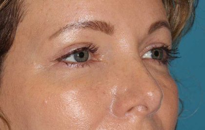 Eyelid Lift Before & After Patient #1736
