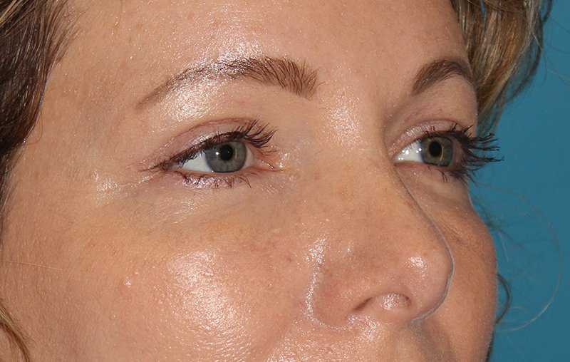 Eyelid Lift Before & After Patient #1736