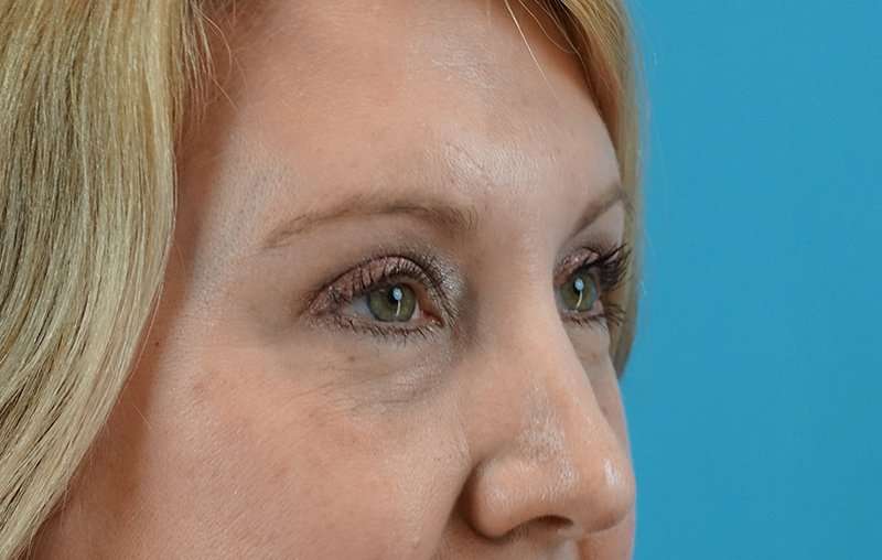 Eyelid Lift Before & After Patient #1747