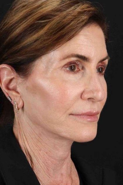 Facelift Before & After Patient #1789