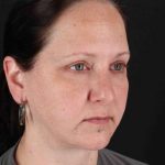 Facelift Before & After Patient #1843