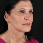 Facelift Before & After Patient #1854
