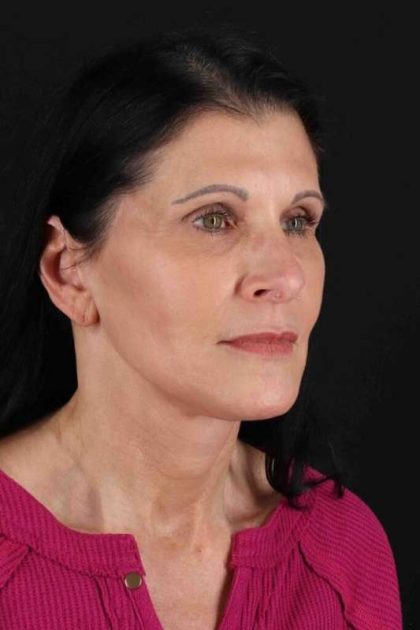 Facelift Before & After Patient #1854