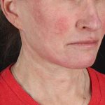 Facelift Before & After Patient #1866