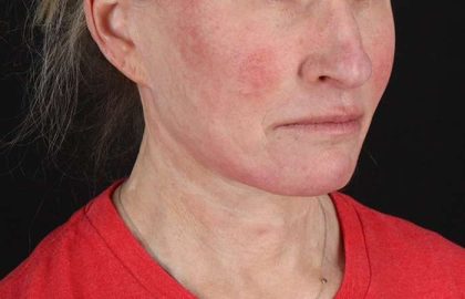Facelift Before & After Patient #1866