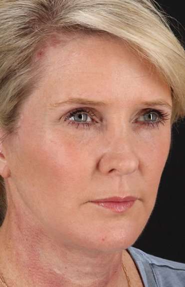 Facelift Before & After Patient #1877