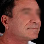 Facelift Before & After Patient #1899