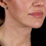 Facelift Before & After Patient #1921
