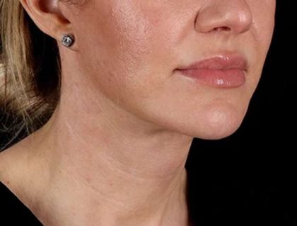 Facelift Before & After Patient #1921