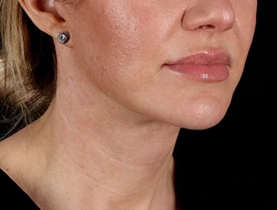 Facelift Before & After Patient #1921
