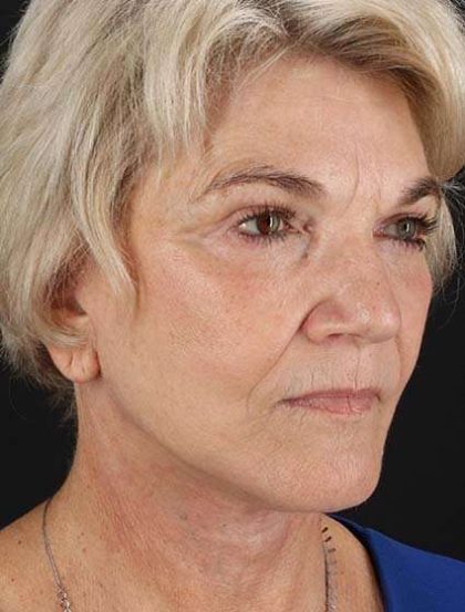Facelift Before & After Patient #1943