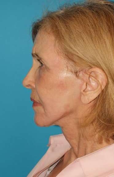 Facelift Before & After Patient #1959