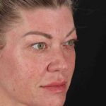 Fat Grafting To The Face Before & After Patient #2016