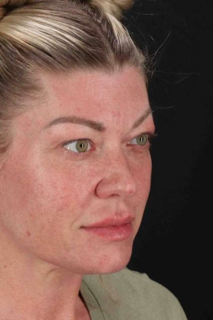 Fat Grafting To The Face Before & After Patient #2016