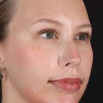 Fillers Before & After Patient #2030