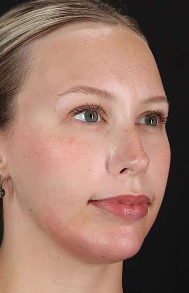 Fillers Before & After Patient #2030