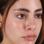 Fillers Before & After Patient #2052
