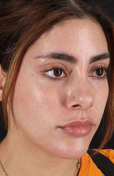 Fillers Before & After Patient #2052
