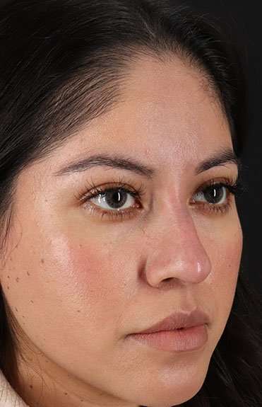 Fillers Before & After Patient #2063