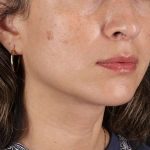 Lip Lift Before & After Patient #2166