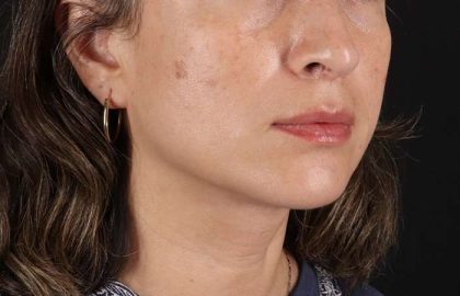 Lip Lift Before & After Patient #2166