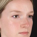 Liquid Rhinoplasty Before & After Patient #2177