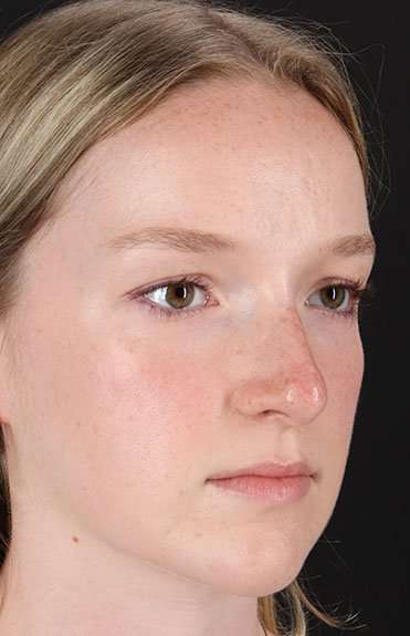 Liquid Rhinoplasty Before & After Patient #2177