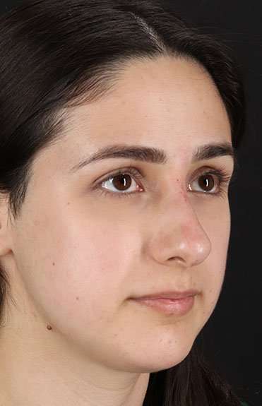 Liquid Rhinoplasty Before & After Patient #2188
