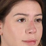 Liquid Rhinoplasty Before & After Patient #2210