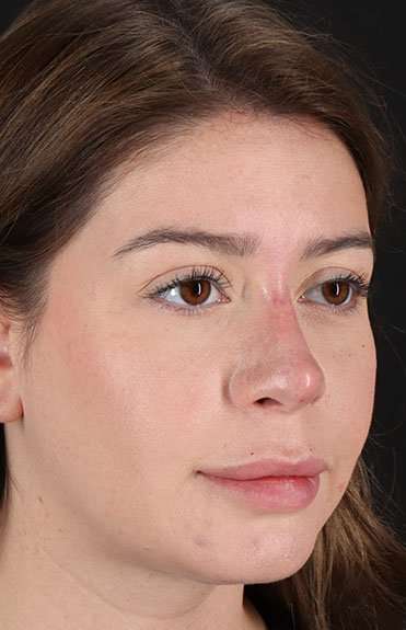 Liquid Rhinoplasty Before & After Patient #2210