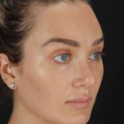 Browlift Before & After Patient #1297