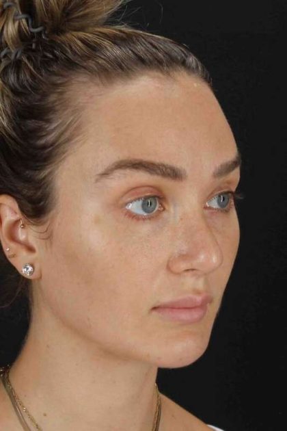 Browlift Before & After Patient #1297