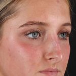Liquid Rhinoplasty Before & After Patient #2221