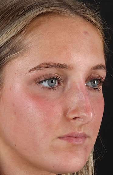Liquid Rhinoplasty Before & After Patient #2221