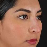 Liquid Rhinoplasty Before & After Patient #2232