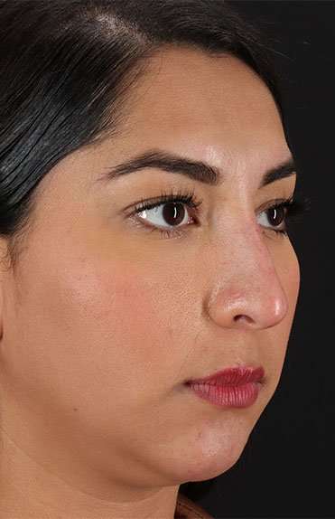 Liquid Rhinoplasty Before & After Patient #2232