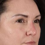 Liquid Rhinoplasty Before & After Patient #2243