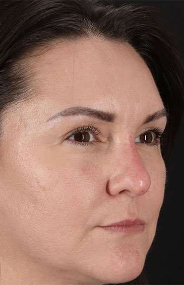 Liquid Rhinoplasty Before & After Patient #2243