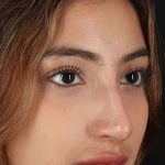 Liquid Rhinoplasty Before & After Patient #2254