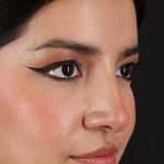 Liquid Rhinoplasty Before & After Patient #2265