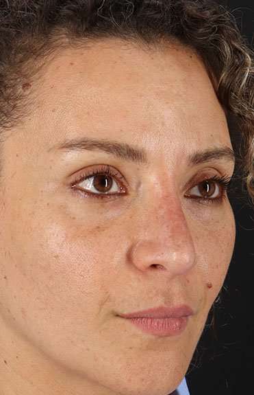 Liquid Rhinoplasty Before & After Patient #2276