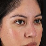 Liquid Rhinoplasty Before & After Patient #2290