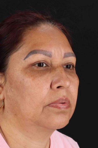 Lower Blepharoplasty Before & After Patient #2321