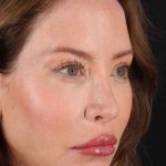 Browlift Before & After Patient #1308