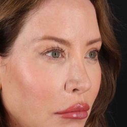 Browlift Before & After Patient #1308
