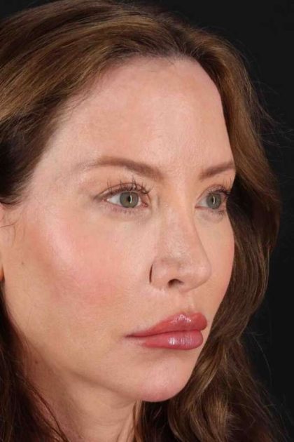 Browlift Before & After Patient #1308