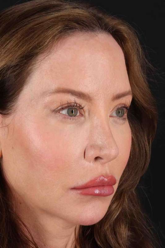 Browlift Before & After Patient #1308
