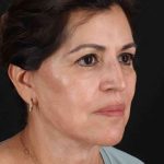 Lower Blepharoplasty Before & After Patient #2343
