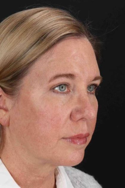 Lower Blepharoplasty Before & After Patient #2376