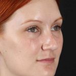 Lower Blepharoplasty Before & After Patient #2409